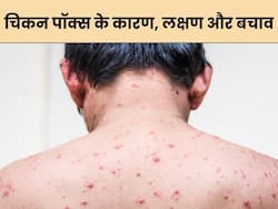 बदलते मौसम में बढ़ जाता है चिकन पॉक्स का खतरा, जानें कारण, लक्षण और उपचार