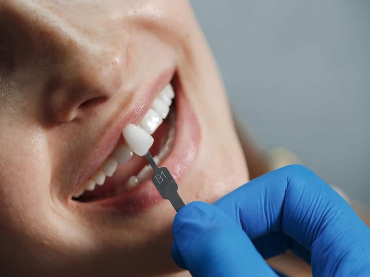 Cosmetic Dentistry, benefits of cosmetic dentistry, what does cosmetic dentistry offer, Crooked teeth, dental veneers, Veneers for teeth, Teeth Whitening, Dental Complications, cosmetic dentistry procedures, cosmetic dentistry options, cosmetic dentistry trend, Aligners for teeth