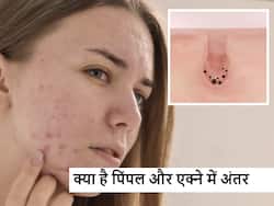 पिंपल और एक्ने में क्या है अंतर जानें स्किन स्पेशलिस्ट डॉक्टर ने दी इस बारे में महत्वपूर्ण जानकारी