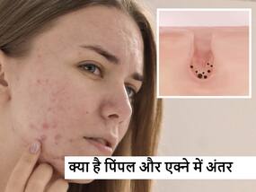 पिंपल और एक्ने में क्या है अंतर जानें स्किन स्पेशलिस्ट डॉक्टर ने दी इस बारे में महत्वपूर्ण जानकारी