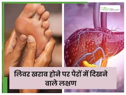 ल‍िवर खराब होने पर पैरों में द‍िखते हैं ये लक्षण, एड़िया भी लगती हैं फटने