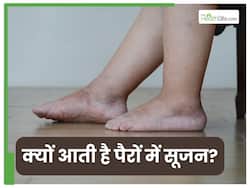 शरीर में क‍िस चीज की कमी से पैरों में सूजन आती है?