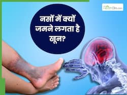 इन कारणों से नसों में बनने लगता है खून का थक्का, डॉक्टर ने बताया इलाज का तरीका