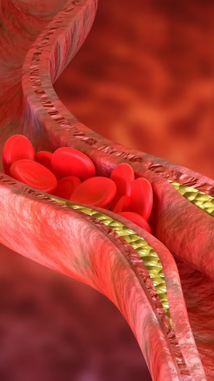 High Cholesterol Diet Tips: 7 Fruits That May Prevent Plaque Formation In Arteries