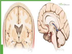Colloid Cysts In Brain: Understanding Symptoms, Diagnosis, And Treatment