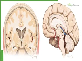 Colloid Cysts In Brain: Understanding Symptoms, Diagnosis, And Treatment