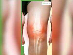 यूरिक एसिड कम करने के लिए खाएं ये फल