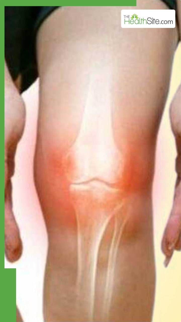 यूरिक एसिड कम करने के लिए खाएं ये फल