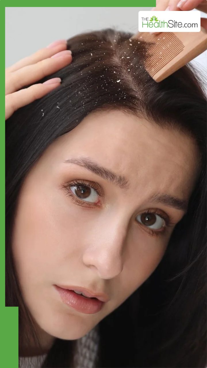 डैंड्रफ से छुटकारा पाने का सबसे आसान उपाय