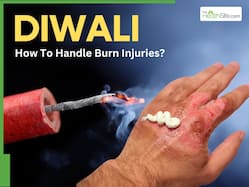 Diwali Safety Tips: How to Treat Firecracker Burns and Injuries At Home Quickly