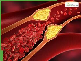 Clogged Arteries: 5 Vitamins That Can Help Prevent Plaque Buildups Naturally