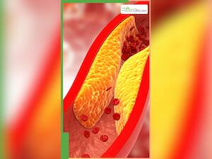 नसों में चिपके कोलेस्ट्रॉल को बाहर निकालते हैं ये फूड