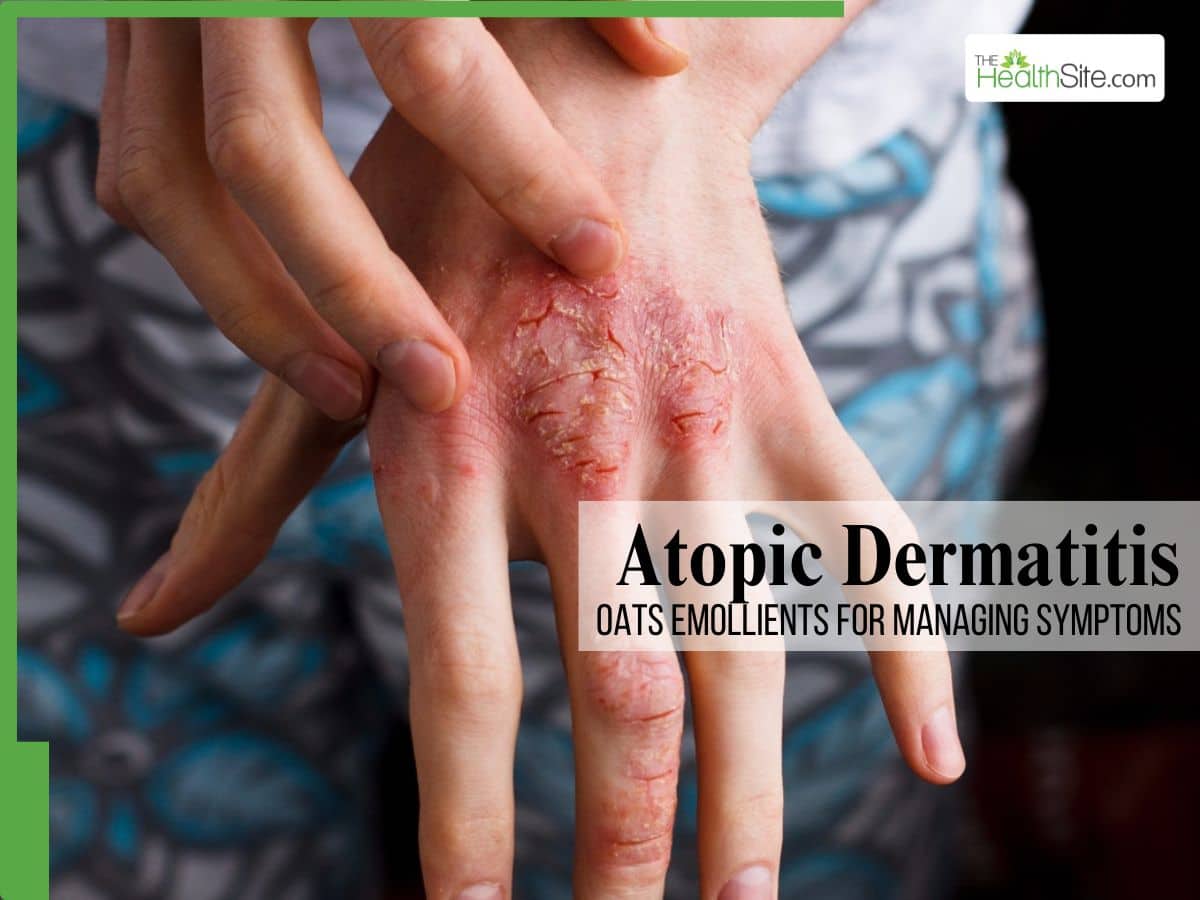 The image focuses on a close-up view of a person’s hands, specifically highlighting the symptoms of Atopic Dermatitis. The hands are positioned centrally, with one hand gently resting over the other. The skin on the back of the hands exhibits clear signs of inflammation and irritation. There’s visible redness, scaling, and areas of dry, cracked skin, particularly around the knuckles and along the fingers. Some areas appear to be actively being scratched or have recently been scratched, with visible skin flaking off. The skin texture is uneven and appears quite distressed. The background is a blurred mix of teal and green hues, creating a contrasting backdrop that draws attention to the affected skin. In the upper right corner, the logo for 'TheHealthSite.com' is visible. Superimposed over the hands and background is text that reads 'Atopic Dermatitis' in a large, bold, white font. Below this, in a smaller font, it states 'OATS EMOLLIENTS FOR MANAGING SYMPTOMS,' indicating the image is likely related to a discussion about using oatmeal-based products to alleviate the symptoms of this skin condition. The overall tone of the image is clinical and informative, aiming to visually represent the physical manifestation of Atopic Dermatitis and suggest a potential remedy.
