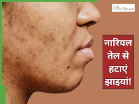 झाइयां हटाने के लिए नारियल तेल में मिलाकर लगा लें ये 3 चीजें, तुरंत मिलेगा रिजल्ट