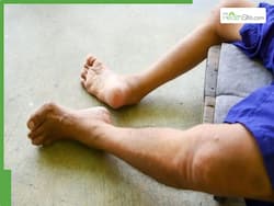 बच्चों में पोलियो होने का खतरा अधिक क्यों, जानें इसके कारण और बचाव के उपाय