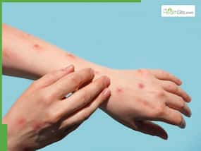 Post-COVID-19 Immunity: Are You More Susceptible To Infections Like Monkeypox?