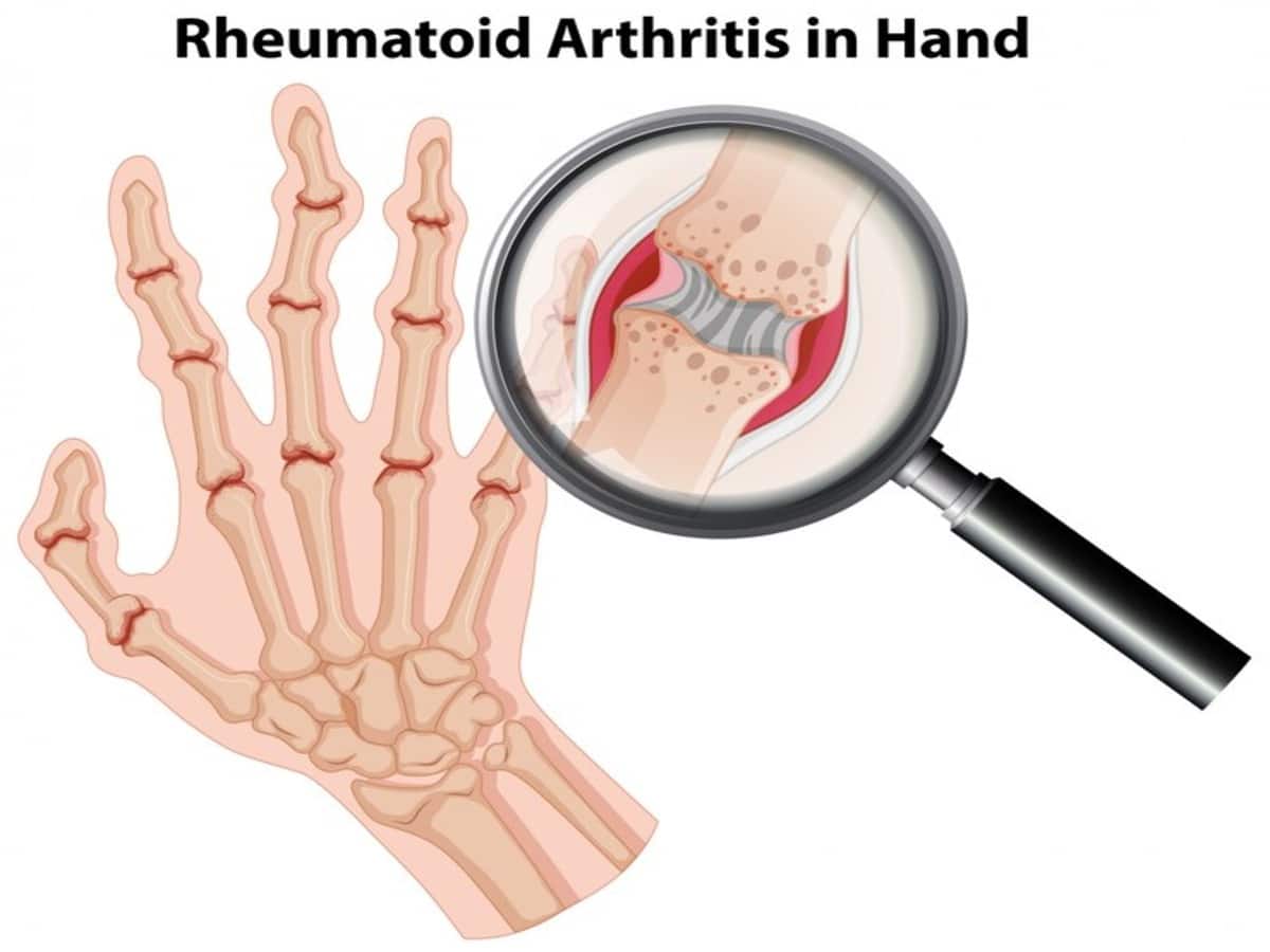 Rheumatoid Arthritis Can Increase Risk Of Lymphoma, Warns A Doctor