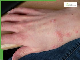 Scabies Cases Spike In The UK: Prevention, Warning Signs You Must Never Ignore Scabies Cases Spike In The UK: Prevention, Warning Signs You Must Never Ignore