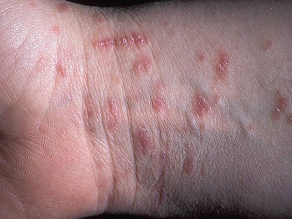 Scabies Cases Spike In The UK: Prevention, Warning Signs You Must Never Ignore
