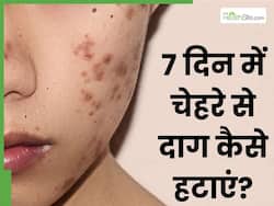 7 दिन में चेहरे के दाग धब्बे हटाने के लिए अपनाएं ये 5 में से 1 नुस्खे, स्किन पर मिनटों में चमक