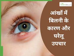 इन 4 कारणों से आंखों में बार-बार होने लगती है बिलनी, घर पर ही कर सकते हैं इसका इलाज