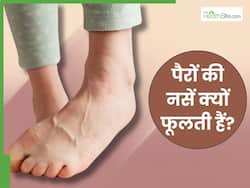इन 5 घातक बीमारियों की वजह से फूलती हैं पैरों की नसें, सूजन देखते ही भागें डॉक्टर के पास