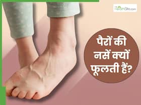 इन 5 घातक बीमारियों की वजह से फूलती हैं पैरों की नसें, सूजन देखते ही भागें डॉक्टर के पास