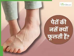 इन 5 घातक बीमारियों की वजह से फूलती हैं पैरों की नसें, सूजन देखते ही भागें डॉक्टर के पास