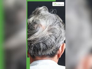 इस विटामिन की कमी से सफेद होते हैं बाल?