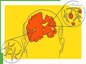 Challenges In Diagnosing Dementia And Alzheimer   s In Diabetic Patients