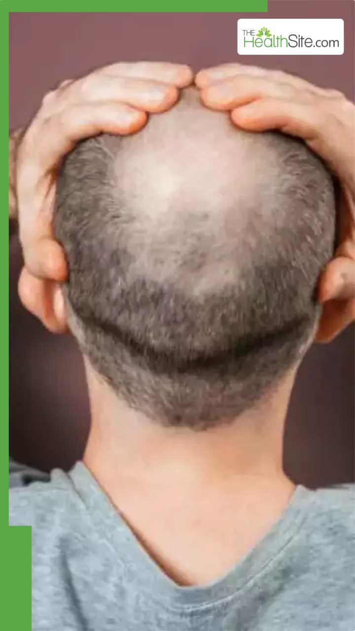 गंजापन दूर करने का सबसे दमदार नुस्खा