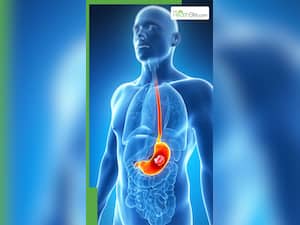 ये 8 मामूली प्रॉब्लम हो सकते हैं पेट कैंसर के संकेत