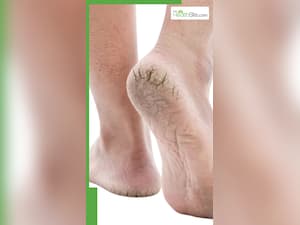 शरीर में इन विटामिन्स की कमी से आती है एड़ियों में दरारें