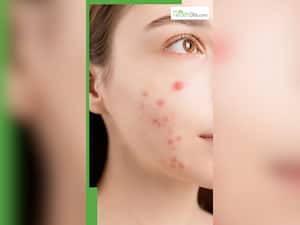 पिंपल्स के निशान को कैसे सही करें?