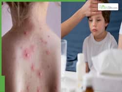 Mpox Vs Common Childhood Illness: How To Differentiate And When To Be Concerned