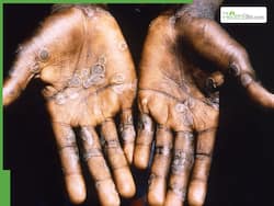Multiple Disease Outbreaks: How Mpox Is Complicating Crowded Viral Disease Space