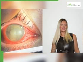 Woman In US Went Swimming With Contact Lenses, Now She Needs Cornea Transplant Woman In US Went Swimming With Contact Lenses, Now She Needs Cornea Transplant
