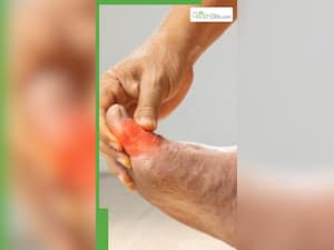 यूरिक एसिड को तुरंत कैसे कम करें?