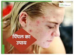 प‍िंपल से छुटकारा पाने के 10 ट‍िप्‍स, आजमाकर देखें, मख्‍खन जैसा च‍िकना होगा गाल