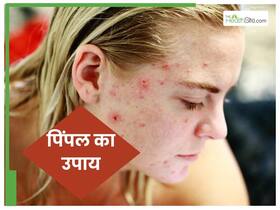 प‍िंपल से छुटकारा पाने के 10 ट‍िप्‍स, आजमाकर देखें, मख्‍खन जैसा च‍िकना होगा गाल