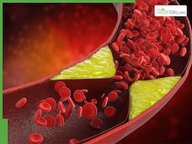 High Cholesterol Management: 5 Tips To Flush Out Bad LDL Naturally And Prevent Nighttime Stroke High Cholesterol Management: 5 Tips To Flush Out Bad LDL Naturally And Prevent Nighttime Stroke
