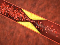 Tips To Prevent Artery Blockage: Can Excess Intake Of Calcium Supplements Lead To Heart Blockage?