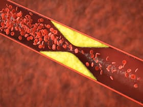 Tips To Prevent Artery Blockage: Can Excess Intake Of Calcium Supplements Lead To Heart Blockage?