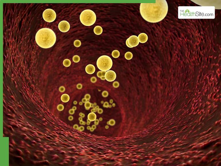 Tips To Lower LDL Cholesterol: Avoid These 6 Foods That Can Spike Bad Cholesterol Instantly