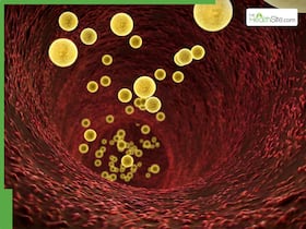 Tips To Lower LDL Cholesterol: Avoid These 6 Foods That Can Spike Bad Cholesterol Instantly