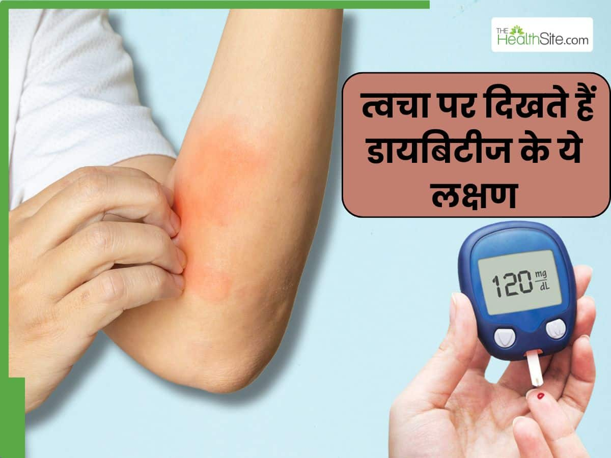 Diabetes Ke Lakshan   स्किन पर नजर आते हैं ...