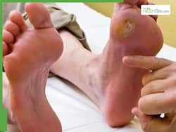 World Diabetes Day: 7 Doctor-Approved Tips To Prevent Diabetic Foot Ulcers
