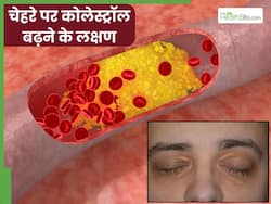 कोलेस्ट्रॉल बढ़ने पर चेहरे पर दिखाई देने लगते हैं ये 5 लक्षण, 90 फीसदी लोग साधारण समझकर करते हैं इग्नोर