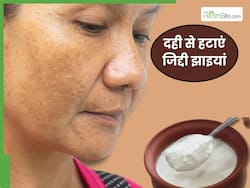 गालों पर झाइयां हटाने के लिए दही का इन 3 तरीकों से करें इस्तेमाल, 1 बार लगाने से ही दिखने लगेगा फर्क