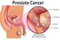 Men's Health Matters: 1 In 8 At Risk For Prostate Cancer; Is Early Detection The Key?